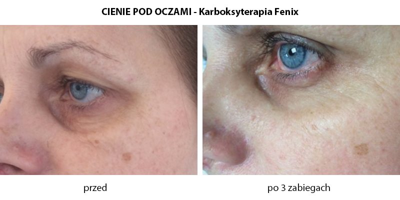 cienie-pod-oczami-Karboksyterapia-Fenix