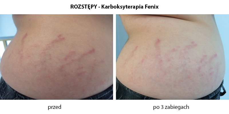 rozstepy-Karboksyterapia-Fenix
